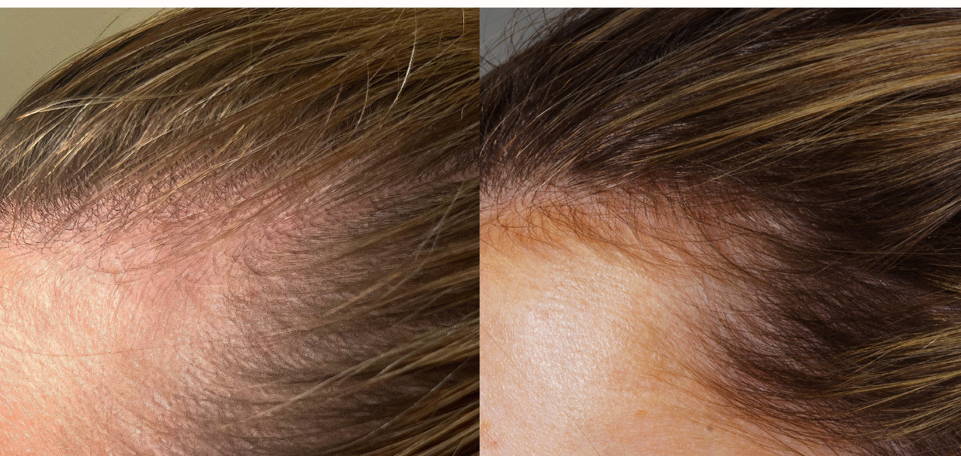 Hair growth progress