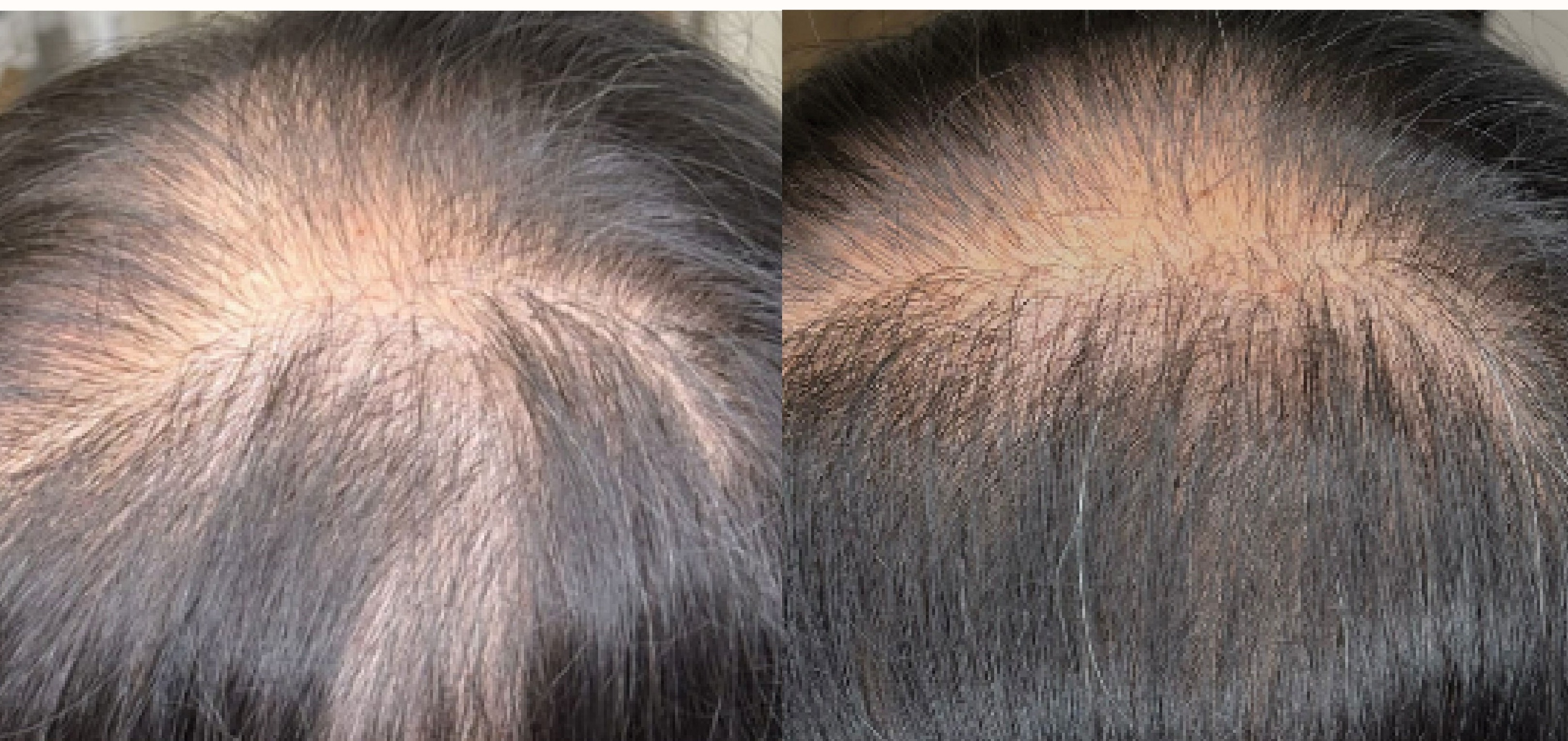 Hair density improvement