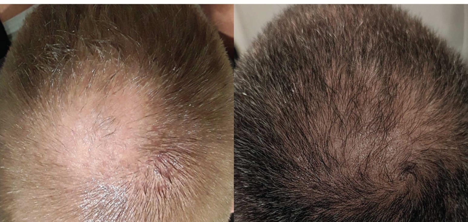 Hair restoration progress