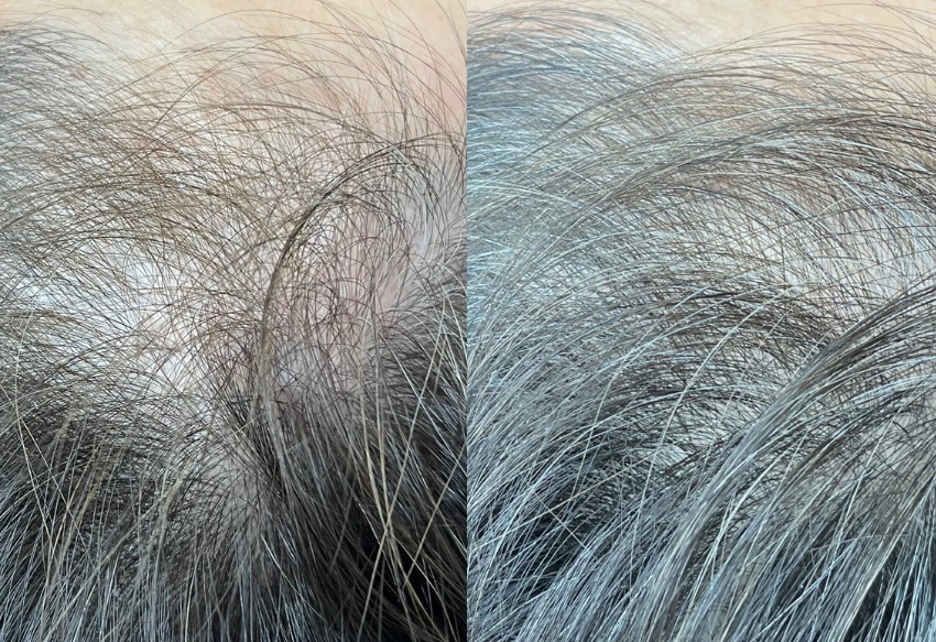 Hair regrowth