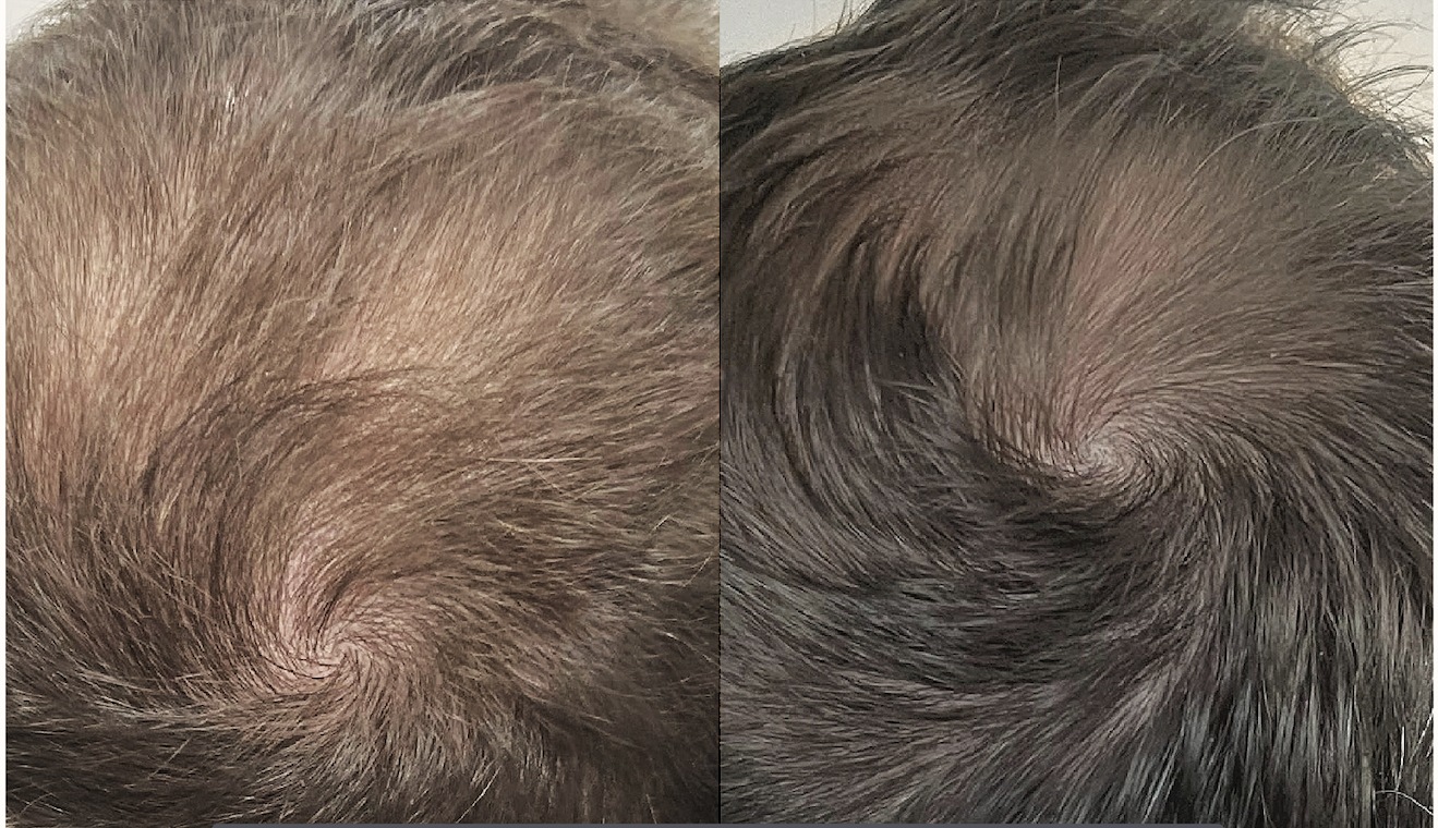 Hair growth results