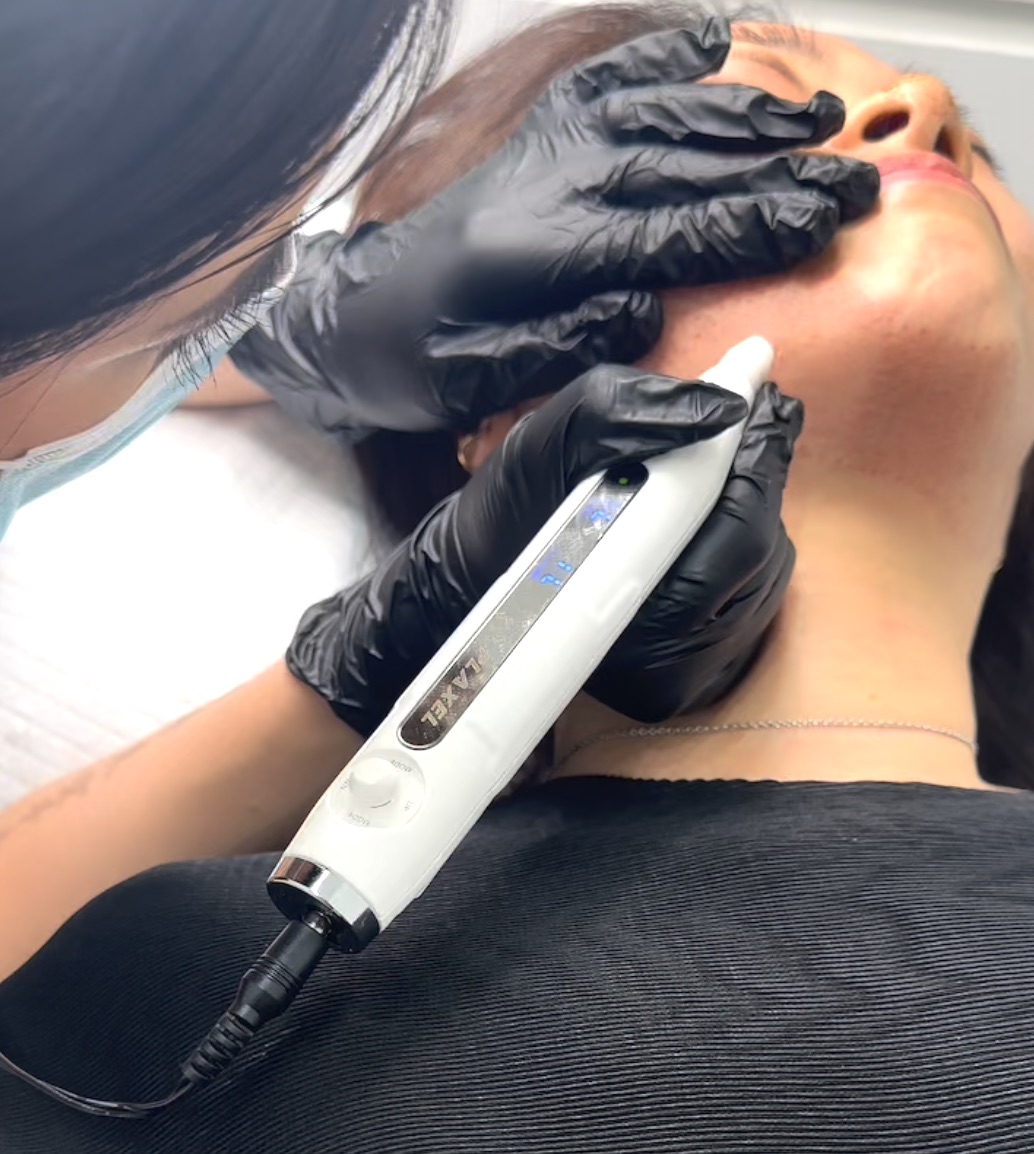 Plasma Fibroblast