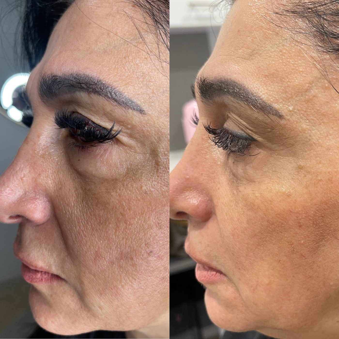 Client skin treatment result 1 at Yuna Skin