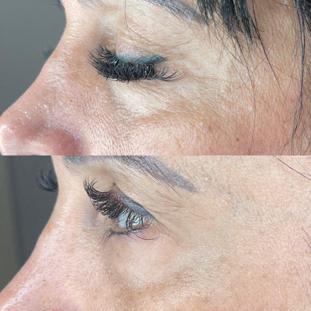 Client skin treatment result 2 at Yuna Skin