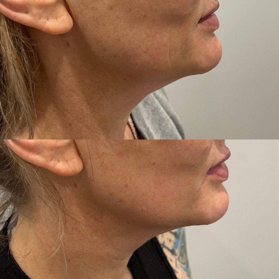 Client skin treatment result 3 at Yuna Skin