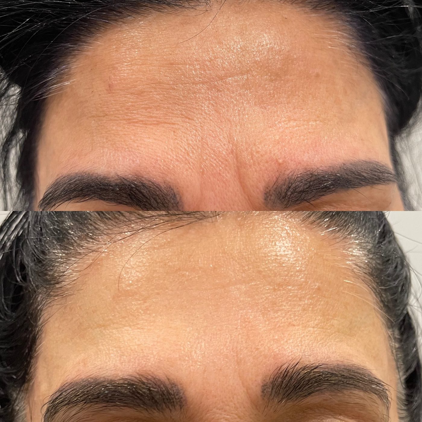 Client skin treatment result 4 at Yuna Skin