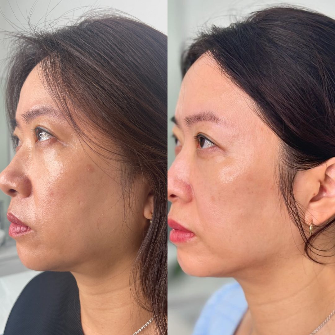 Client skin treatment result 5 at Yuna Skin