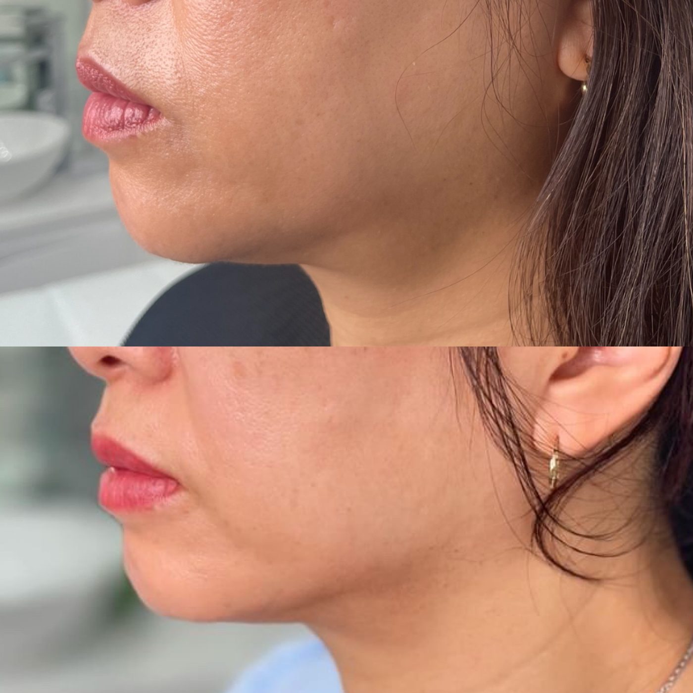 Client skin treatment result 6 at Yuna Skin