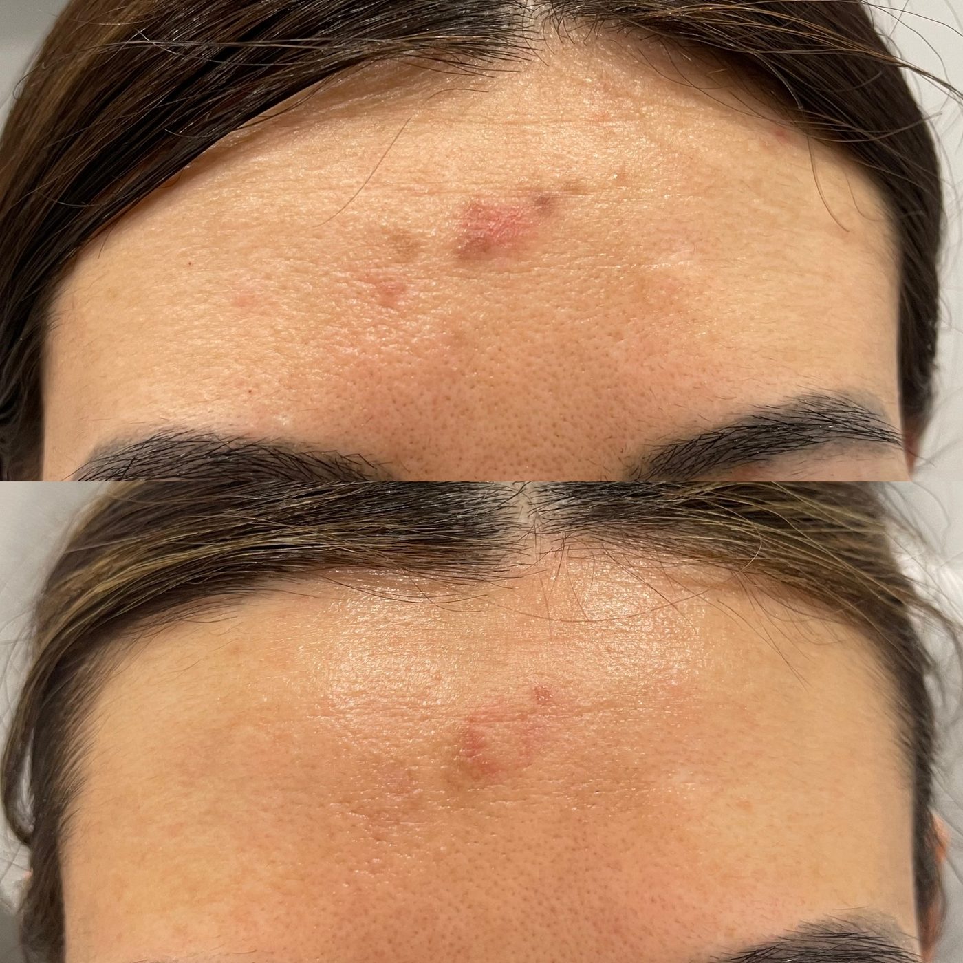 Client skin treatment result 7 at Yuna Skin
