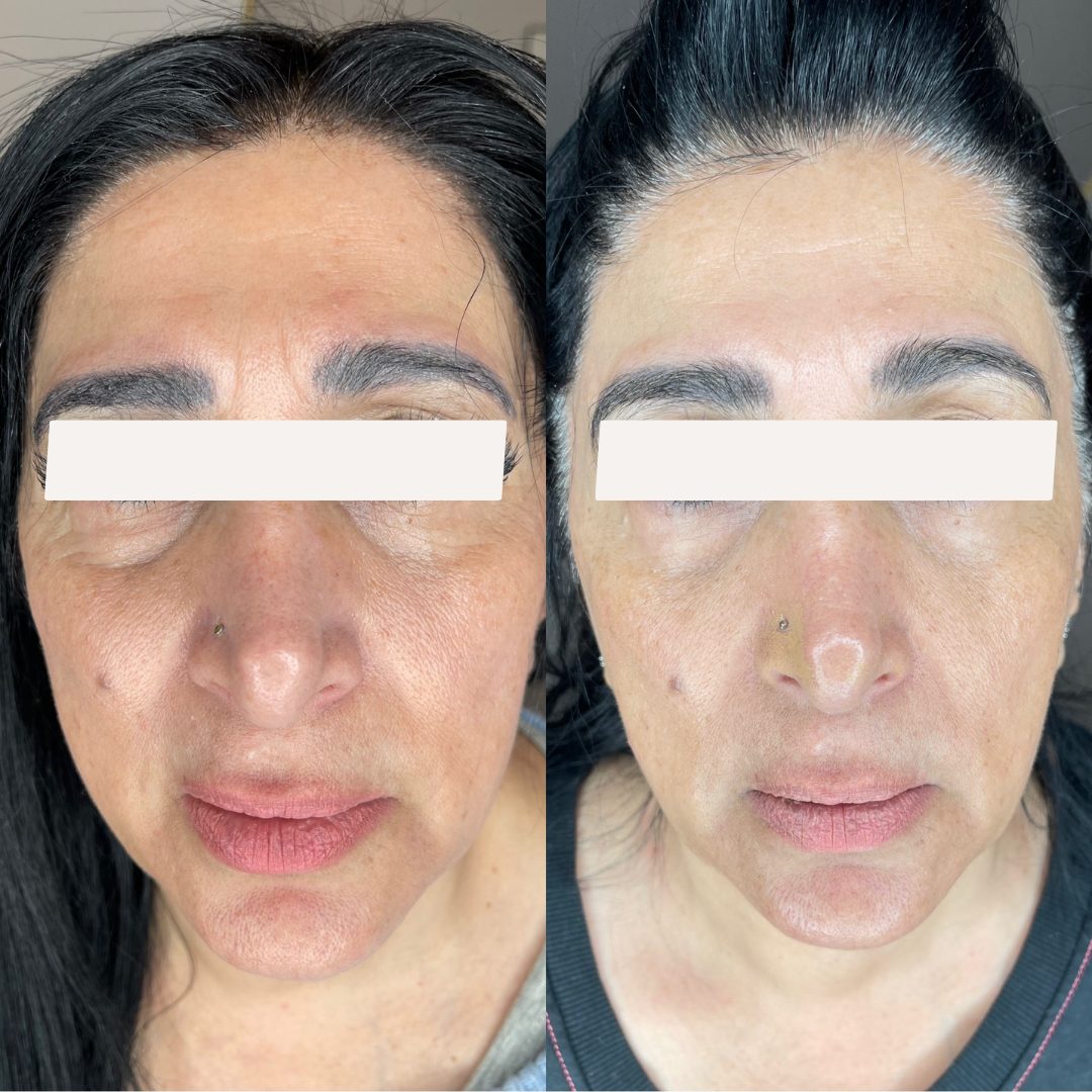 Client skin treatment result 8 at Yuna Skin