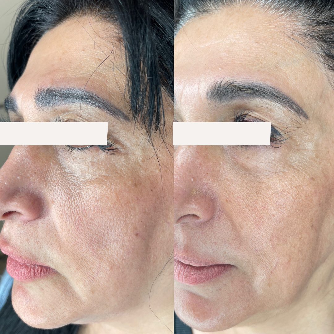 Client skin treatment result 9 at Yuna Skin