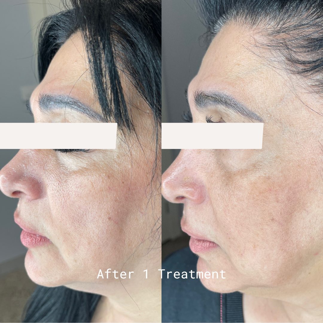 Client skin treatment result 10 at Yuna Skin